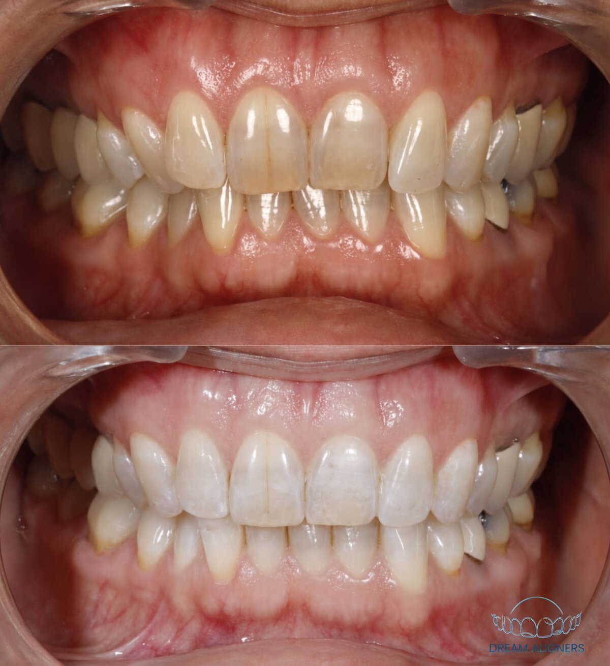 Dentition avant et après traitement par aligneurs Dream Aligners