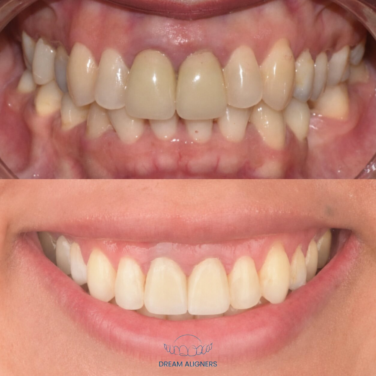 Sourire d'un patient avant et après Dream Aligners