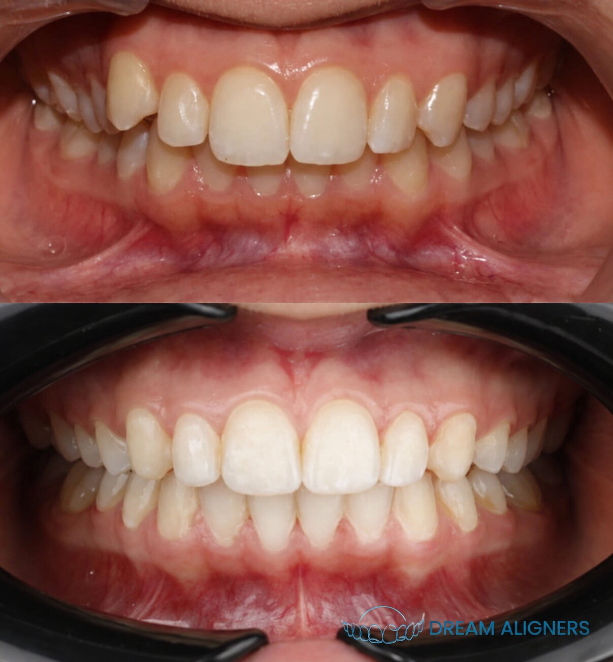 Dents avant et après aligneurs transparents Dream Aligners