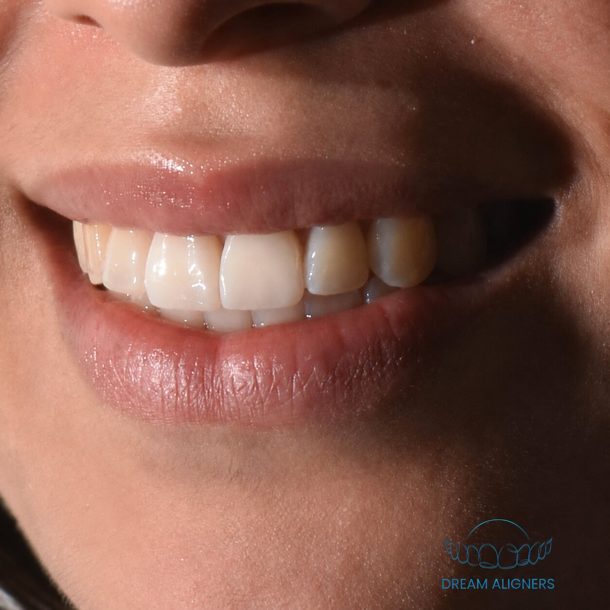 Patiente souriante avec ses dents alignées grâce à Dream Aligners