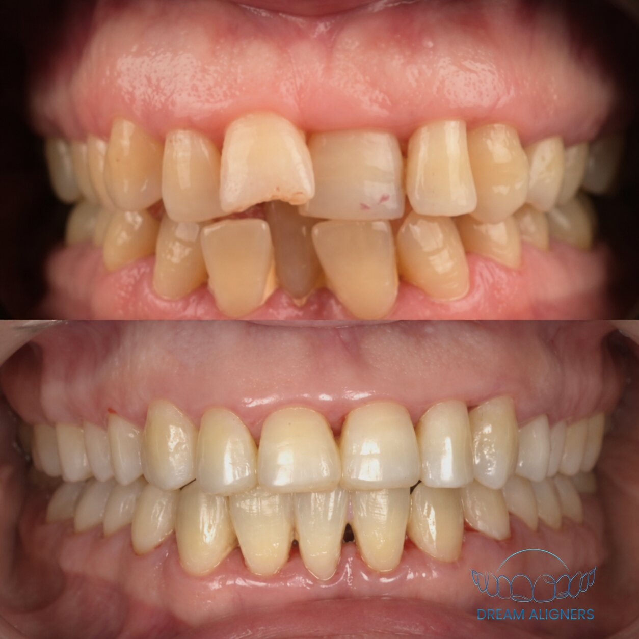 Encombrement dentaire corrigé avec Dream Aligners, avant et après
